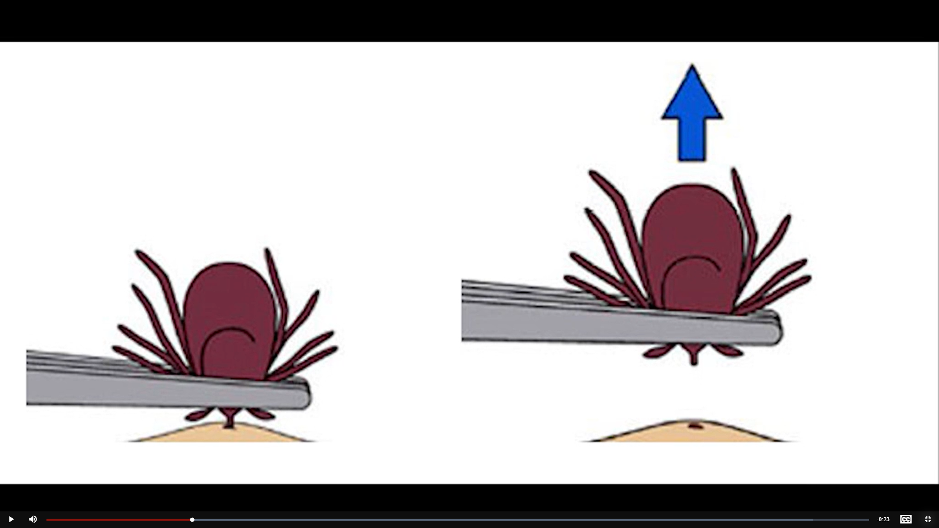 How to Safely Remove a Tick which has Embedded in the Skin